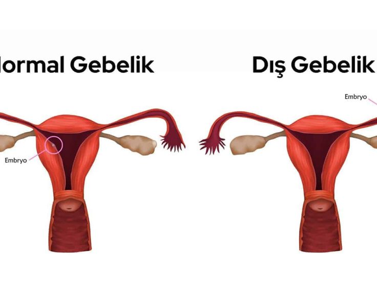 Dış-gebelik Dış-gebelik