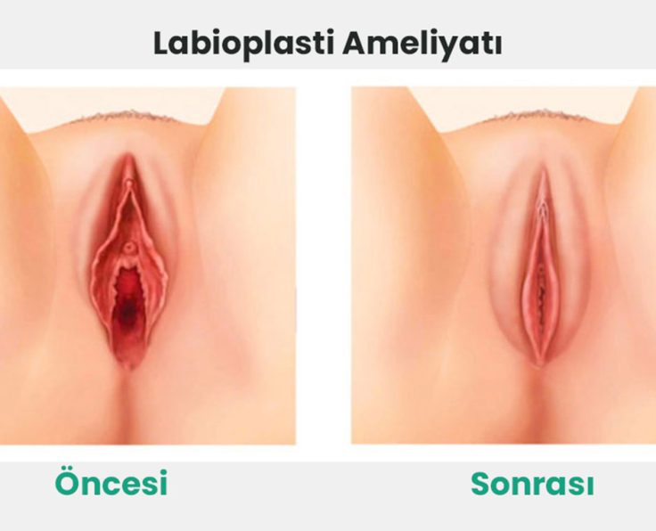 labiplasti labiplasti